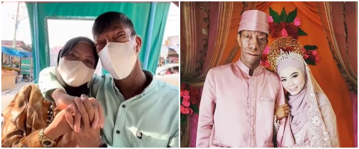 9 Potret cantik istri Surya Manurung pria pengidap sindrom langka