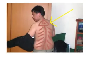 11 Gaya kerokan ini paling lucu, bikin ngakak sampai perut mules!