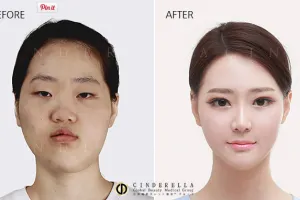 15 Foto keajaiban oplas Korsel yang bikin kamu bilang 'kok bisa ya?'