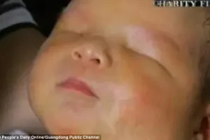 Bayi mungil nan menggemaskan ini lahir tanpa mata
