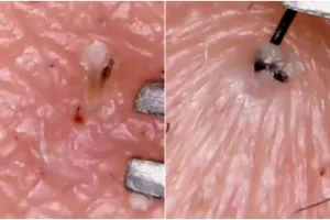 Video blackhead komedo yang berhasil dicabut, menjijikkan ya?