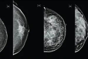 Teknologi terbaru ultrasonik lebih akurat deteksi kanker payudara