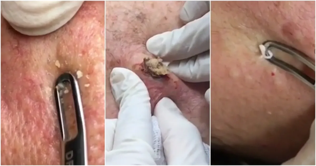 10 Video jerawat & komedo berhasil dicabut ini bikin puas ngelihatnya