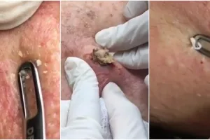 10 Video jerawat & komedo berhasil dicabut ini bikin puas ngelihatnya