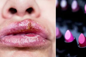 Bibir cewek ini kena herpes setelah pakai lipstik, kok bisa?