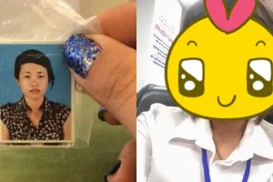 Lakukan operasi plastik, transformasi cewek ini bikin melongo