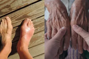 7 Penyebab asam urat dan cara mengatasinya, mudah dan alami