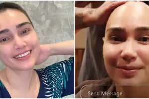 Feby Febiola botaki kepala akibat kanker, dukungan sahabat bikin haru