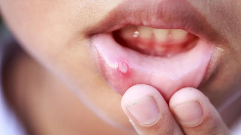 Manfaat berkumur dengan air garam © 2020 brilio.net Manfaat berkumur dengan air garam © 2020 brilio.net