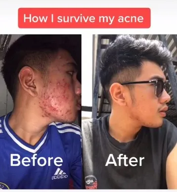 Transformasi lelaki pernah gendut dan jerawatan TikTok/@opaldenhari Transformasi lelaki pernah gendut dan jerawatan TikTok/@opaldenhari