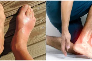 8 Ciri-ciri asam urat yang umum dialami, cegah sejak dini