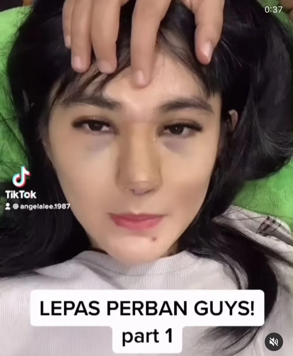 Angela Lee usai operasi hidung Instagram