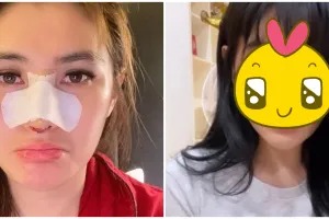 8 Potret terbaru Angela Lee usai operasi hidung, parasnya manglingi