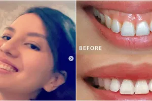 8 Potret terbaru Tya Ariestya usai operasi potong gusi, menawan