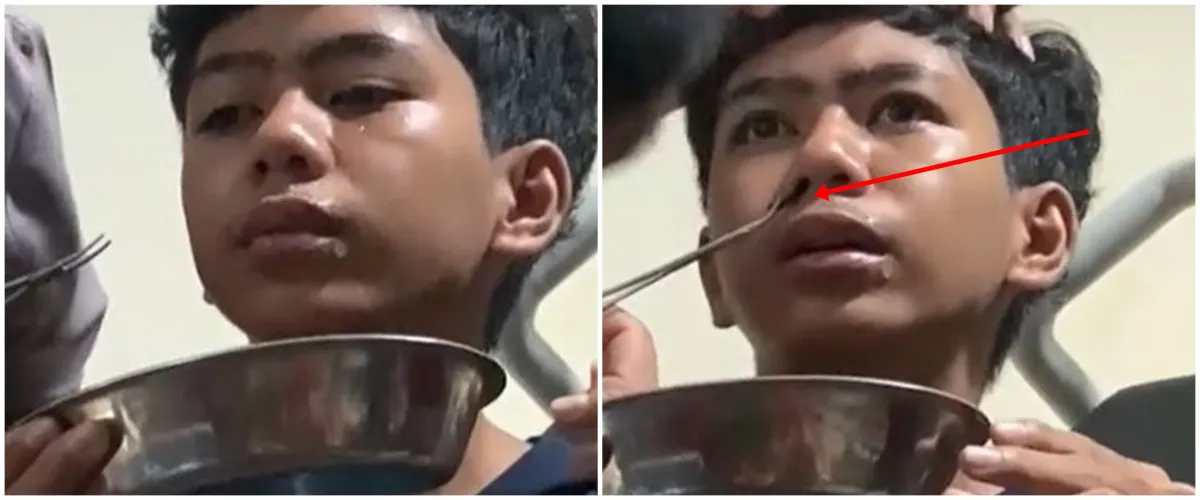 Heboh lintah ditemukan di hidung pria ini, warganet auto cek hidung