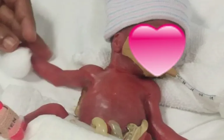 Bayi terkecil di dunia © Istimewa