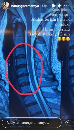 Hanung Bramantyo alami ruas leher menyempit © Instagram/@hanungbramantyo Hanung Bramantyo alami ruas leher menyempit © Instagram/@hanungbramantyo
