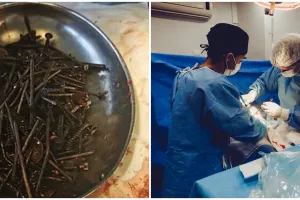 Aneh tapi nyata, 1 kg paku hingga skrup ditemukan dalam perut pria