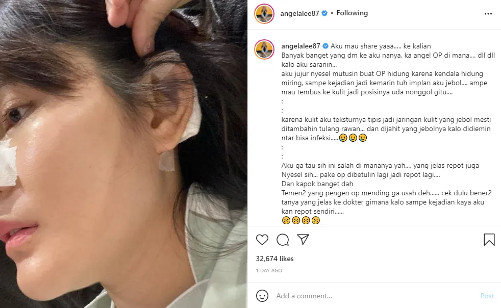 Kondisi Angela Lee usai operasi hidung Instagram Kondisi Angela Lee usai operasi hidung Instagram