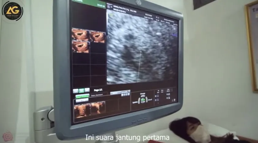 momen Adiezty dan Gilang Dirga cek kandungan © YouTube