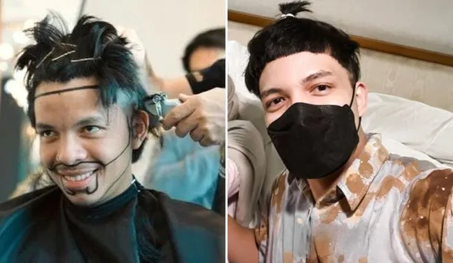 seleb usai transplantasi rambut Berbagai sumber seleb usai transplantasi rambut Berbagai sumber