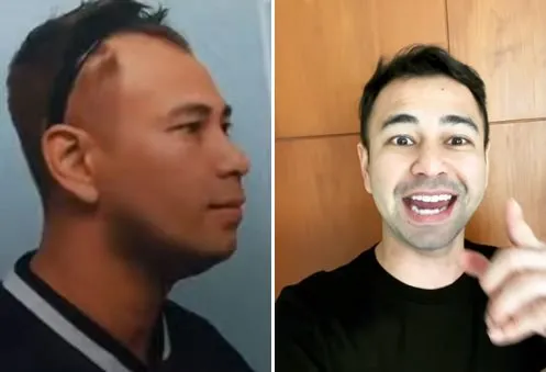 seleb usai transplantasi rambut Berbagai sumber seleb usai transplantasi rambut Berbagai sumber