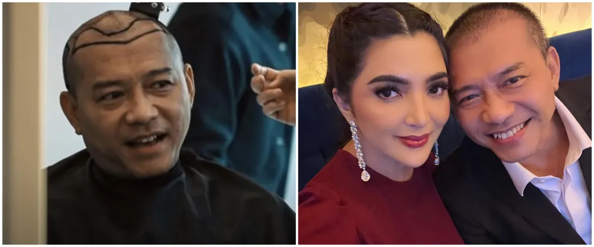 9 Potret Anang Hermansyah sebelum dan sesudah transplantasi rambut