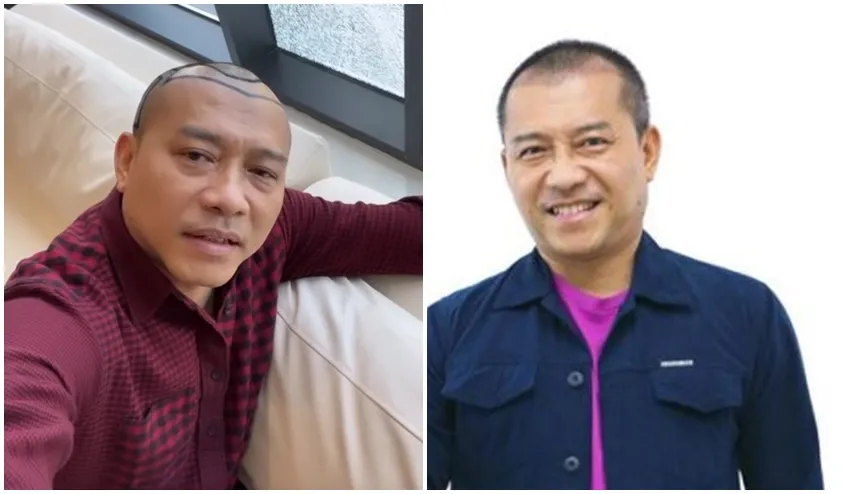 Anang Hermansyah sebelum dan sesudah transplantasi rambut © Instagram Anang Hermansyah sebelum dan sesudah transplantasi rambut © Instagram