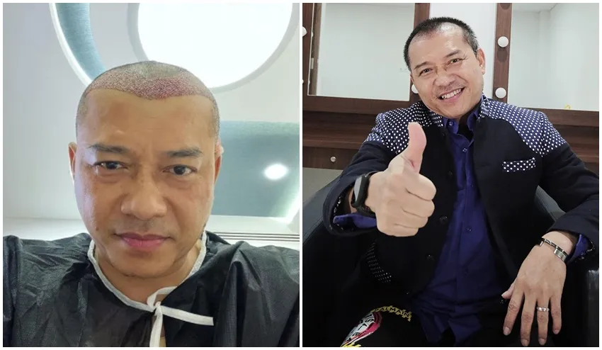 Anang Hermansyah sebelum dan sesudah transplantasi rambut © Instagram Anang Hermansyah sebelum dan sesudah transplantasi rambut © Instagram