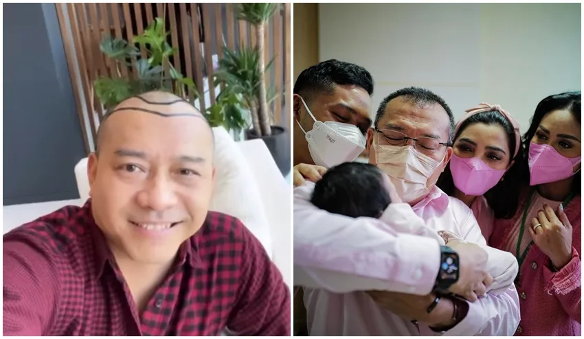 Anang Hermansyah sebelum dan sesudah transplantasi rambut © Instagram Anang Hermansyah sebelum dan sesudah transplantasi rambut © Instagram