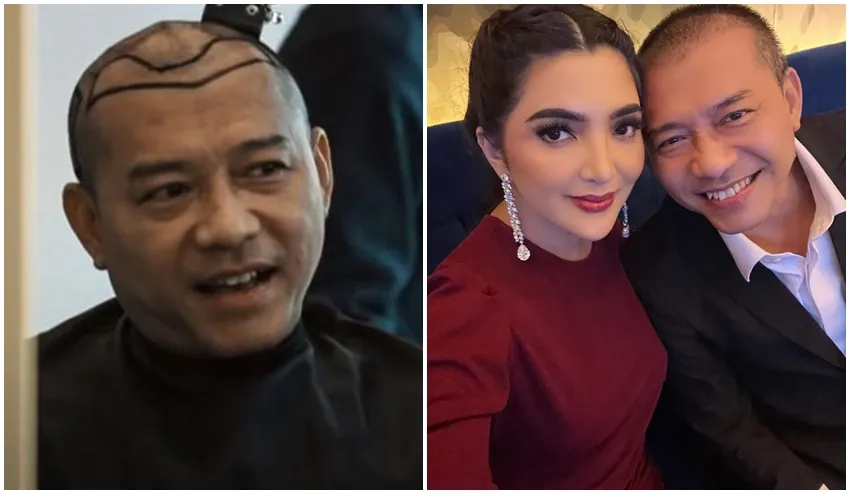 Anang Hermansyah sebelum dan sesudah transplantasi rambut © Instagram Anang Hermansyah sebelum dan sesudah transplantasi rambut © Instagram