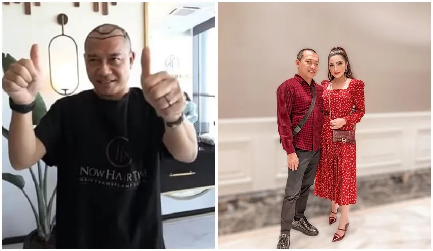 Anang Hermansyah sebelum dan sesudah transplantasi rambut © Instagram Anang Hermansyah sebelum dan sesudah transplantasi rambut © Instagram