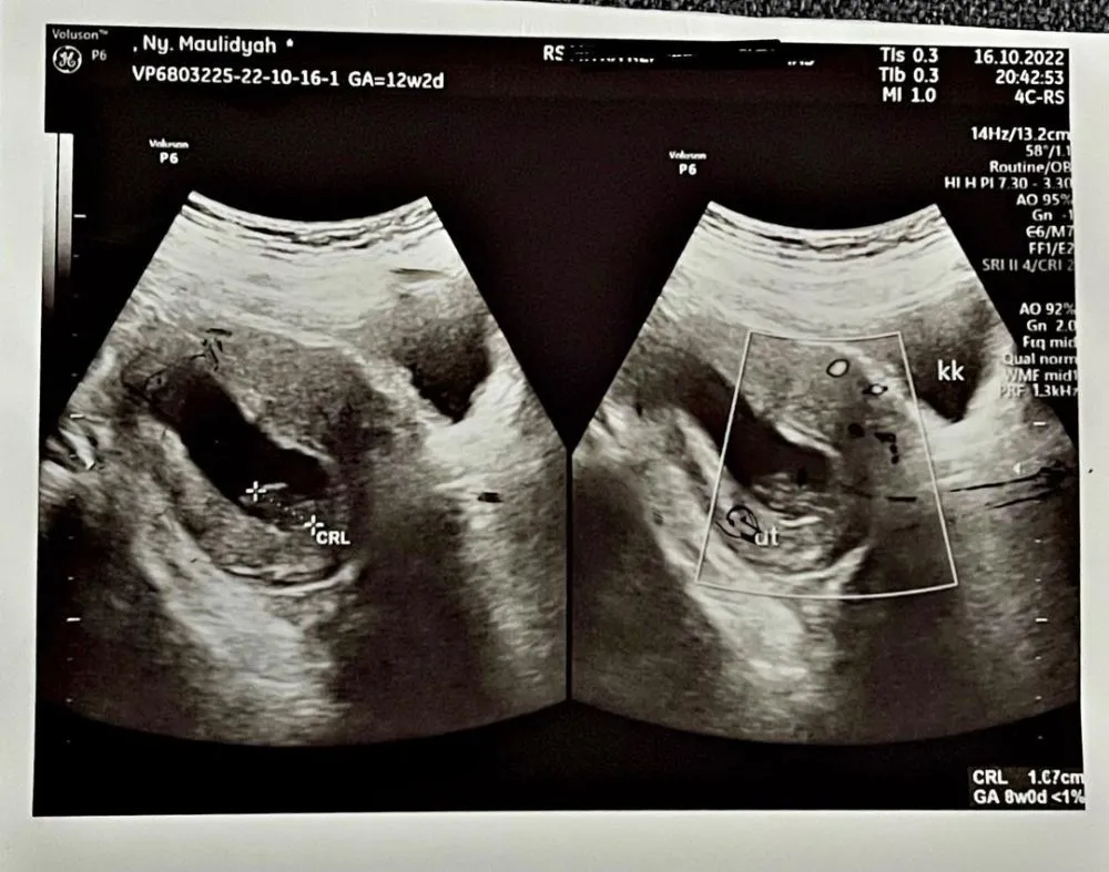 via vallen keguguran © Instagram