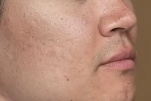 Hanya pakai satu jenis tanaman herbal, begini cara menghilangkan bekas bopeng agar wajah kembali mulus