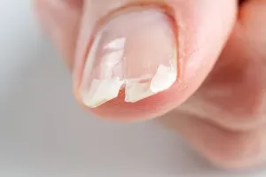 Trik mengatasi kuku rapuh dan kuning pakai serum dari 2 bahan dapur, bikin berkilau dan cerah alami