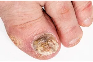 Tak perlu lemon, ini cara atasi kulit ujung jari retak dan kering menguning pakai 2 bahan alami