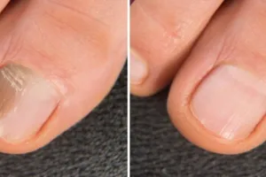 Tak perlu manicure di salon, ini trik atasi kuku kuning berjamur pakai 1 bahan pemanis