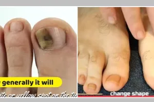 Tak gunakan bawang putih, ini cara mengatasi jamur kuku kaki menguning pakai 1 ekstrak buah