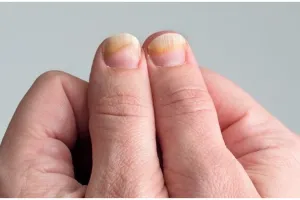 Tanpa pergi ke salon kecantikan, ini cara atasi kuku rapuh dan kusam pakai 1 bahan sayuran