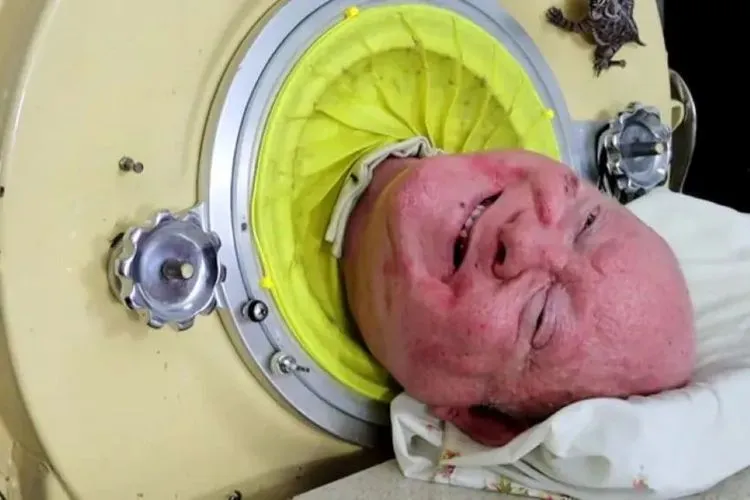 Kenali gejala dan penyebab polio © Freepik