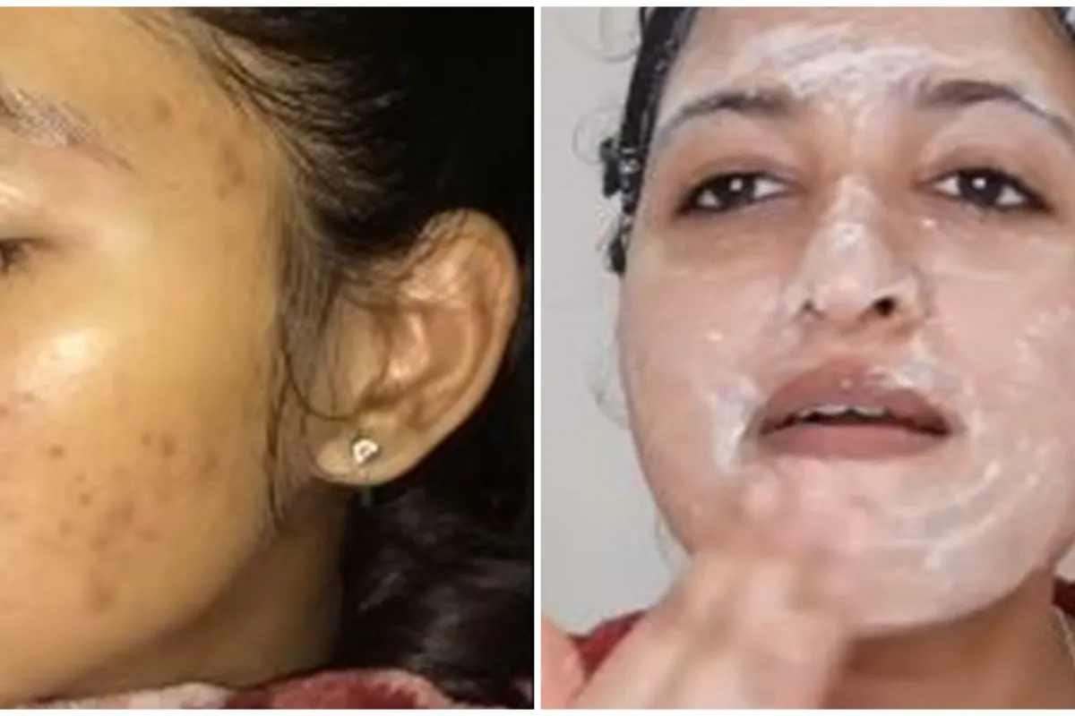 Tanpa teh hijau, ini cara hilangkan flek hitam di pipi pakai tepung beras dikombinasikan 3 bahan alami