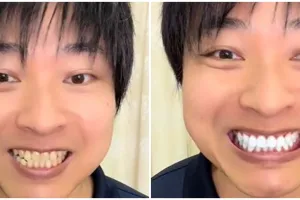 Nggak cuma lemon, pria ini bagikan cara atasi gigi tampak menguning pakai tambahan 1 bahan dapur