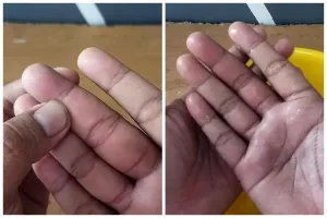 Bukan diolesi pasta gigi, ini trik agar tangan tak bengkak usai terkena sengatan tawon
