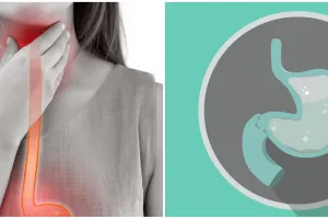 9 Komplikasi yang disebabkan karena asam lambung, ubah gaya hidup demi kesehatan jangka panjang