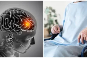 Sering diabaikan, ternyata ini 7 kebiasaan sehari-hari yang memicu stroke di usia muda