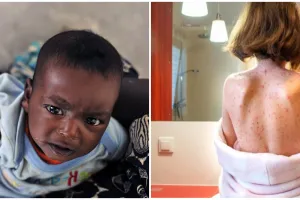 Waspada campak pada anak, kenali penyebab, gejala, dan cara pengobatannya