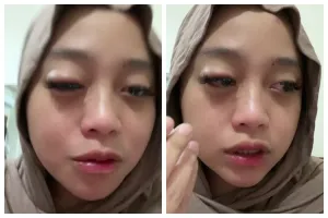 Akibat teledor pakai soft lens hingga mata kering, cewek ini alami iritasi hingga bengkak