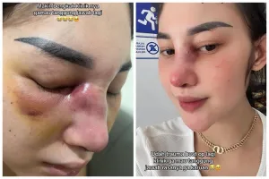 Kisah cewek gagal operasi hidung bukannya jadi lebih mancung, hasilnya justru bikin infeksi