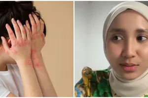 Wanita ini terkena herpes usai coba produk tester make up, kenali herpes, penyebab, & cara mengatasi