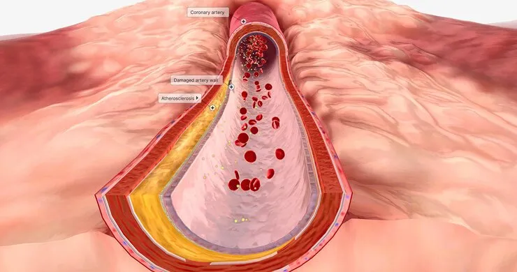 Kadar trigliserida tinggi bisa sebabkan stroke freepik.com